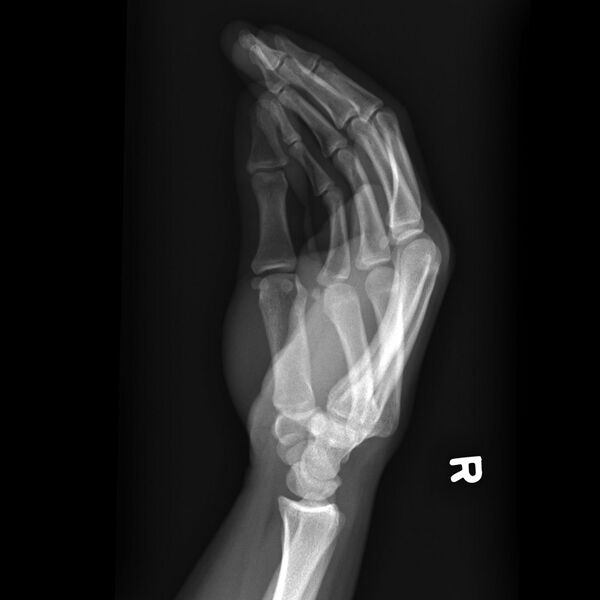 File:Carpometacarpal fracture dislocation (Radiopaedia 12674-12852 Lateral 1).jpg