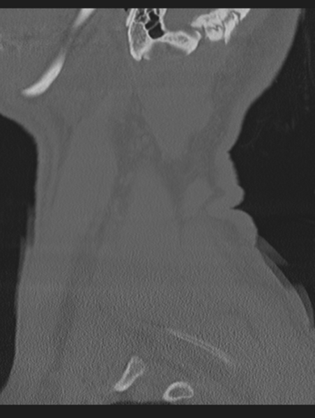 File:Cavernoma of cervical cord (Radiopaedia 50838-56346 Sagittal bone window 74).png