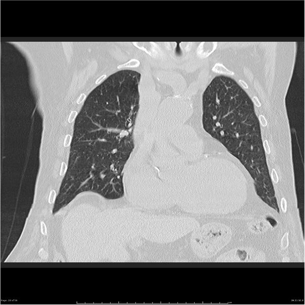 File:Cavitating left lower lobe lesion - squamous cell lung cancer (Radiopaedia 27749-28176 Coronal lung window 20).jpg