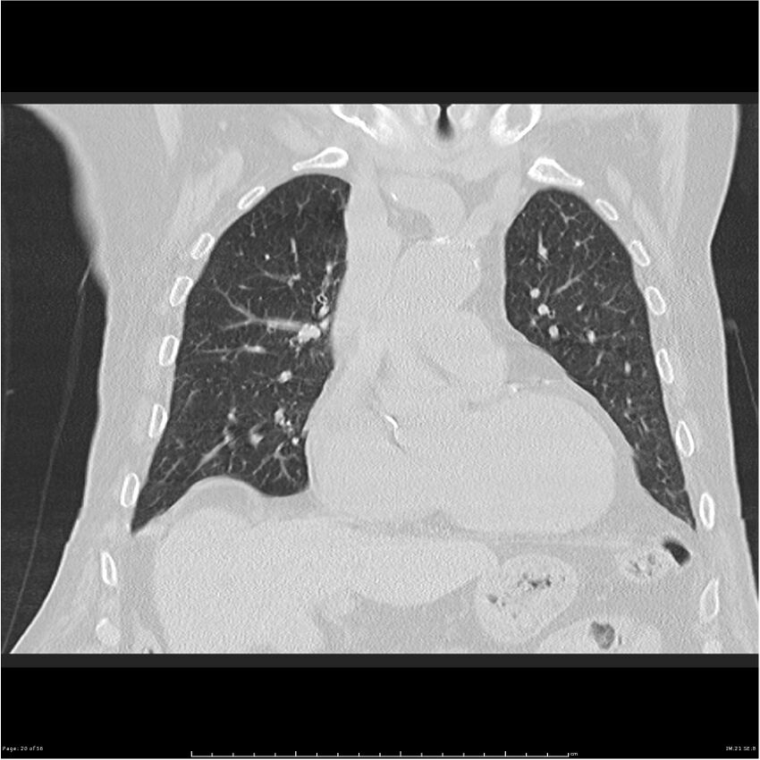 Cavitating left lower lobe lesion - squamous cell lung cancer (Radiopaedia 27749-28176 Coronal lung window 20).jpg