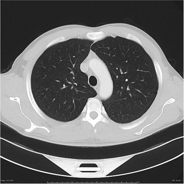 File:Cavitating lung cancer (Radiopaedia 25796-25945 Axial lung window 14).jpg