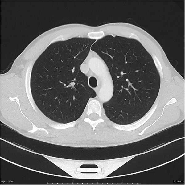 File:Cavitating lung cancer (Radiopaedia 25796-25945 Axial lung window 15).jpg