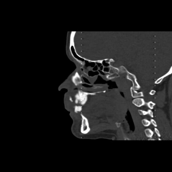 File:Cemento-ossifying fibroma (Radiopaedia 21243-21149 Sagittal bone window 10).jpg