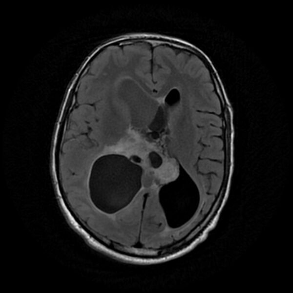 File:Central neurocytoma (Radiopaedia 67618-77021 Axial FLAIR 14).jpg