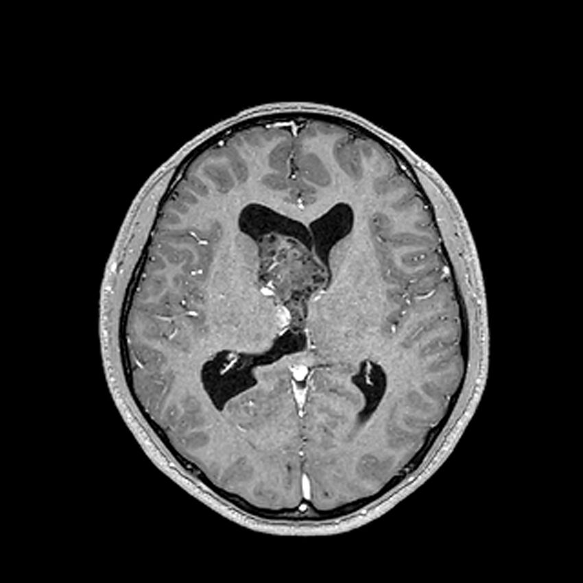 Central neurocytoma (Radiopaedia 79320-92380 Axial T1 C+ 132).jpg