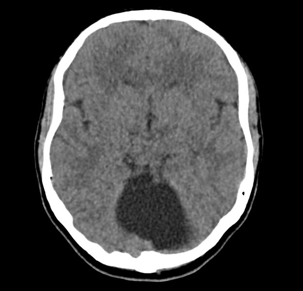 File:Cerebellar agenesis (Radiopaedia 30203-30817 Axial non-contrast 17).jpg