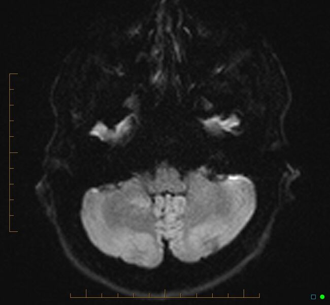File:Cerebellar gangliocytoma (Radiopaedia 65377-74422 Axial DWI 8).jpg
