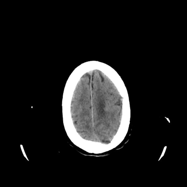 File:Cerebellar metastasis - lung tumor (Radiopaedia 69317-79145 Axial non-contrast 32).jpg