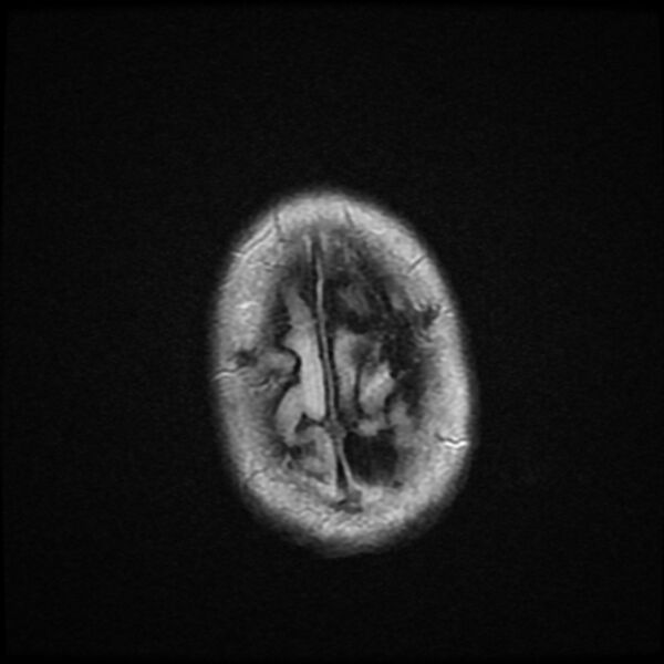 File:Cerebellar metastasis - lung tumor (Radiopaedia 69317-79147 Axial FLAIR 1).jpg