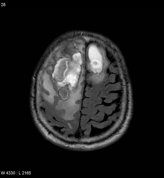 File:Cerebral abscesses secondary to contusions (Radiopaedia 5201-6968 Axial FLAIR 7).jpg