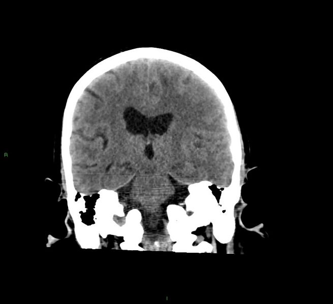 File:Cerebral amyloid angiopathy-associated lobar intracerebral hemorrhage (Radiopaedia 58529-65681 Coronal non-contrast 31).jpg