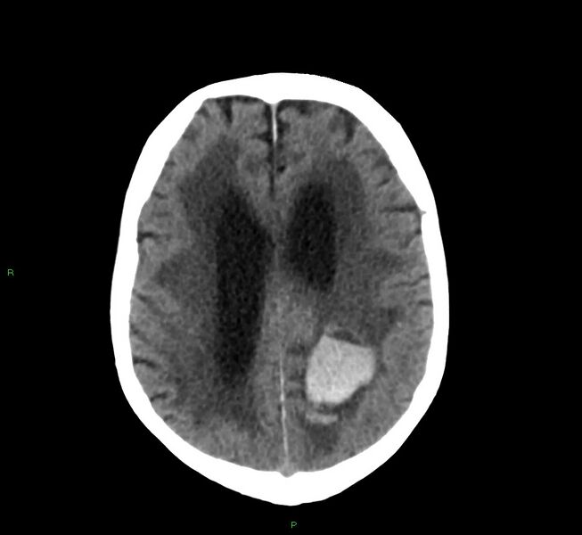 File:Cerebral amyloid angiopathy-associated lobar intracerebral hemorrhage (Radiopaedia 58530-65688 Axial non-contrast 17).jpg