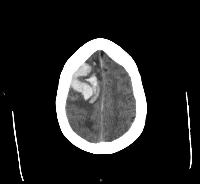 File:Cerebral amyloid angiopathy-associated lobar intracerebral hemorrhage (Radiopaedia 58560-65723 Axial non-contrast 12).jpg
