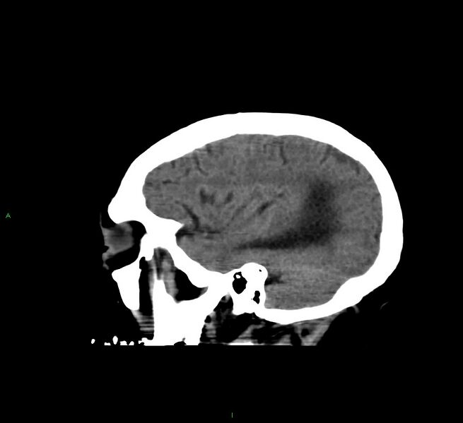 File:Cerebral amyloid angiopathy-associated lobar intracerebral hemorrhage (Radiopaedia 58560-65723 C 40).jpg