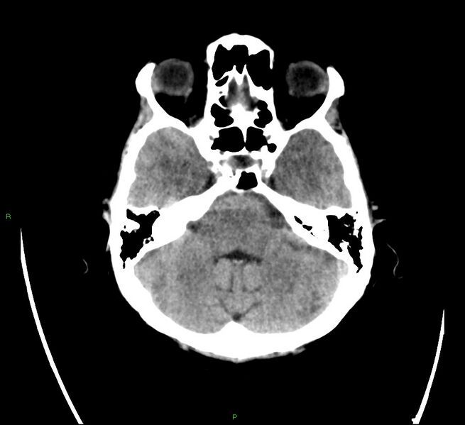 File:Cerebral amyloid angiopathy-associated lobar intracerebral hemorrhage (Radiopaedia 58566-65731 Axial non-contrast 6).jpg