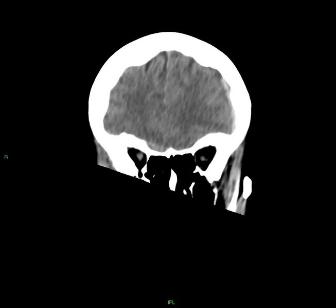 File:Cerebral amyloid angiopathy-associated lobar intracerebral hemorrhage (Radiopaedia 58754-65975 Coronal non-contrast 47).jpg