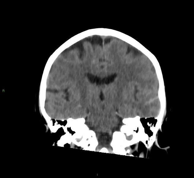 File:Cerebral amyloid angiopathy-associated lobar intracerebral hemorrhage (Radiopaedia 58757-65978 Coronal non-contrast 34).jpg