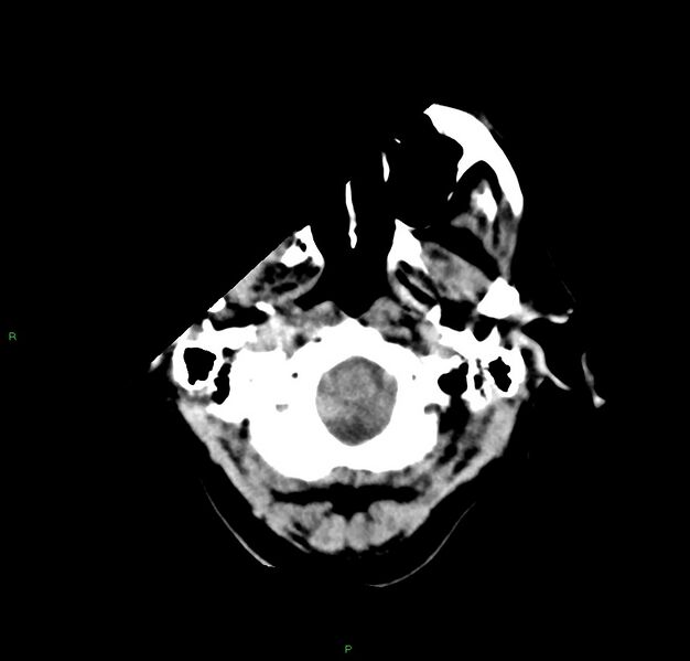 File:Cerebral amyloid angiopathy-associated lobar intracerebral hemorrhage (Radiopaedia 59356-66716 Axial non-contrast 44).jpg