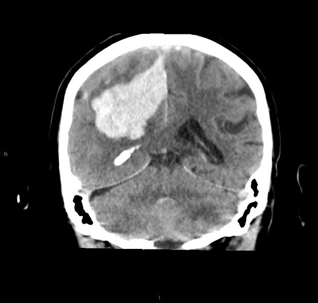File:Cerebral amyloid angiopathy-associated lobar intracerebral hemorrhage (Radiopaedia 59356-66716 Coronal non-contrast 25).jpg