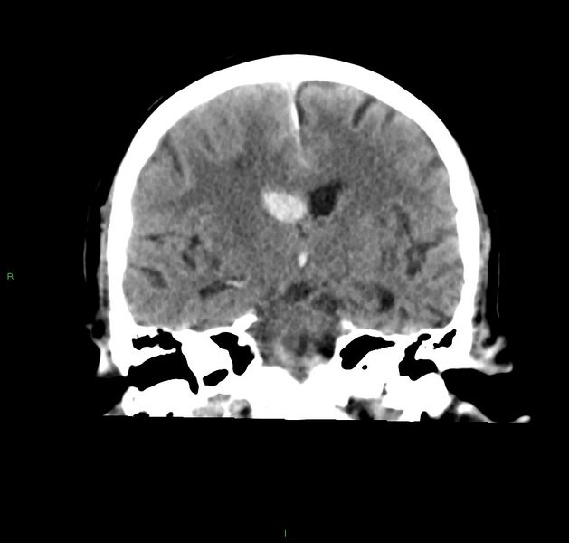 File:Cerebral amyloid angiopathy-associated lobar intracerebral hemorrhage (Radiopaedia 59356-66716 Coronal non-contrast 35).jpg