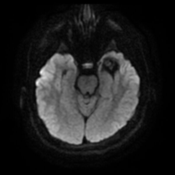 File:Cerebral cavernous malformation (Radiopaedia 44301-47942 Axial DWI 8).jpg