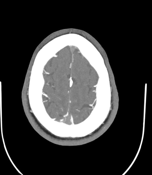 File:Cerebral dural venous sinus thrombosis (Radiopaedia 86514-102576 A 82).jpg