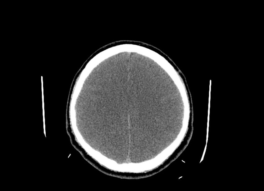 Cerebral edema (Radiopaedia 82519-96661 Axial non-contrast 18).jpg