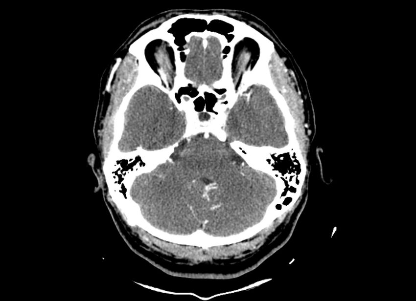 Cerebral edema (Radiopaedia 82519-96661 B 43).jpg