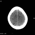 Cerebral hemorrhagic contusion with subdural and subarachnoid hemorrhage (Radiopaedia 10680-11146 Axial non-contrast 23).jpg