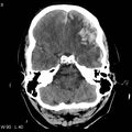 Cerebral hemorrhagic contusion with subdural and subarachnoid hemorrhage (Radiopaedia 10680-19197 Axial non-contrast 4).jpg