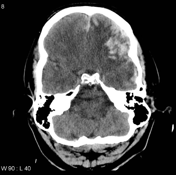 File:Cerebral hemorrhagic contusion with subdural and subarachnoid hemorrhage (Radiopaedia 10680-19197 Axial non-contrast 4).jpg