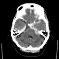 Cerebral hemorrhagic contusions (Radiopaedia 23145-23188 Axial non-contrast 10).jpg