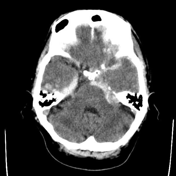 File:Cerebral hemorrhagic contusions (Radiopaedia 23145-23188 Axial non-contrast 10).jpg