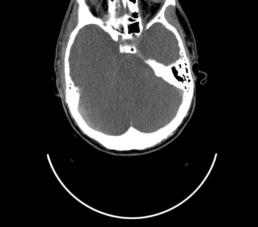 Cerebral ring enhancing lesions - cerebral metastases (Radiopaedia 44922-48818 B 138).jpg
