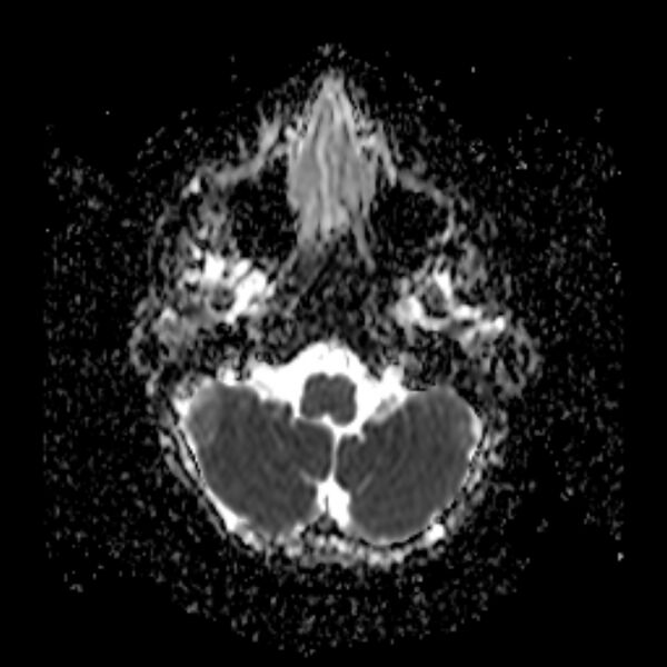 File:Cerebral tuberculoma (Radiopaedia 41152-43932 Axial ADC 3).jpg