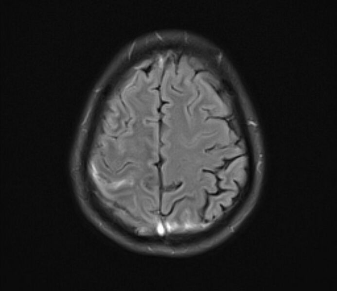 File:Cerebral venous thrombosis (Radiopaedia 71207-81504 Axial FLAIR 21).jpg