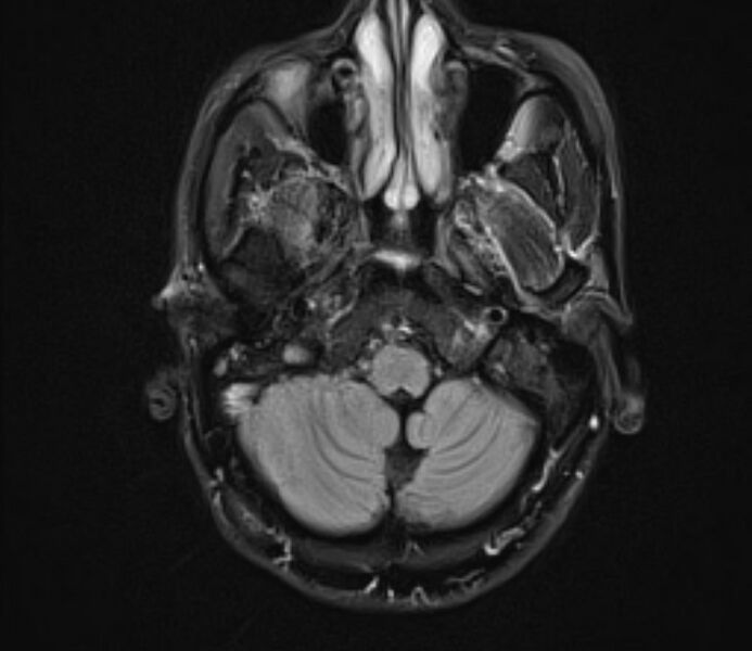 File:Cerebral venous thrombosis (Radiopaedia 71207-81504 Axial FLAIR 6).jpg