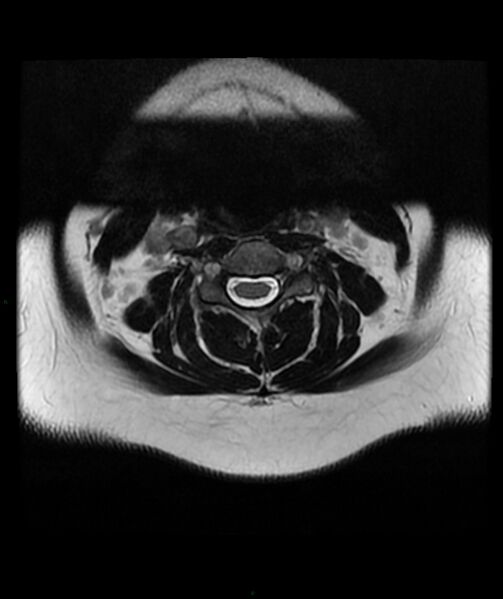 File:Cervical disc prolapse (Radiopaedia 80258-93598 Axial T2 17).jpg