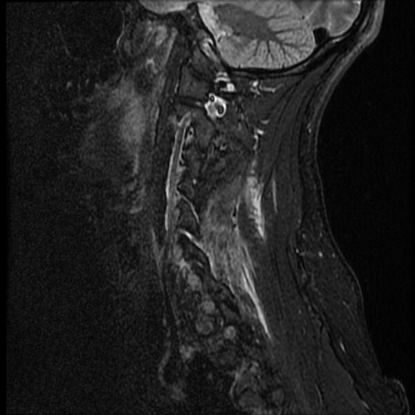 File:Cervical facet fracture and anterior discoligamentous injury (Radiopaedia 32139-33084 Sagittal STIR 14).jpg