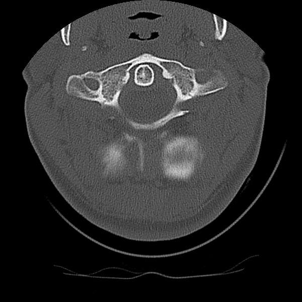 File:Cervical flexion teardrop fracture with cord hemorrhage (Radiopaedia 32497-33454 Axial bone window 16).jpg