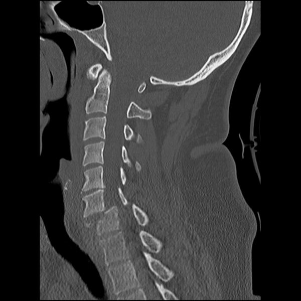 File:Cervical fracture and dislocation with locked facet (Radiopaedia 31837-32780 Sagittal bone window 14).jpg