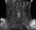 Cervical schwannoma (Radiopaedia 72399-82934 G 7).jpg