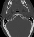 Cervical spine ACDF loosening (Radiopaedia 48998-54070 Axial bone window 10).png