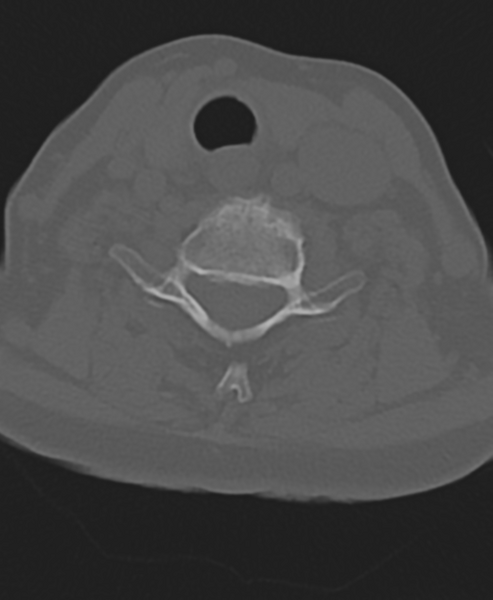 File:Cervical spine ACDF loosening (Radiopaedia 48998-54071 Axial bone window 42).png