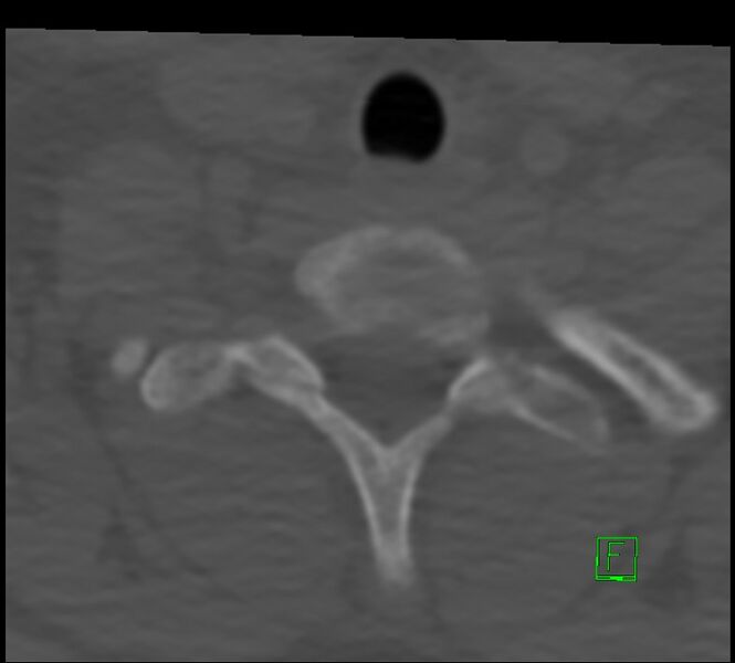File:Cervical spine fracture - hyperflexion injury (Radiopaedia 66184-75364 Axial bone window 51).jpg