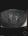 Cesarian scar endometriosis (Radiopaedia 68495-78066 Axial T1 C+ fat sat 7).jpg