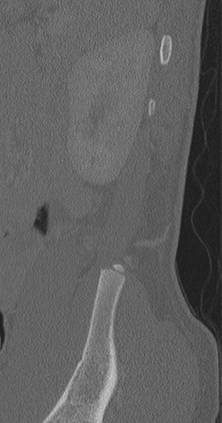 File:Chance fracture (Radiopaedia 40360-42912 Sagittal bone window 7).png