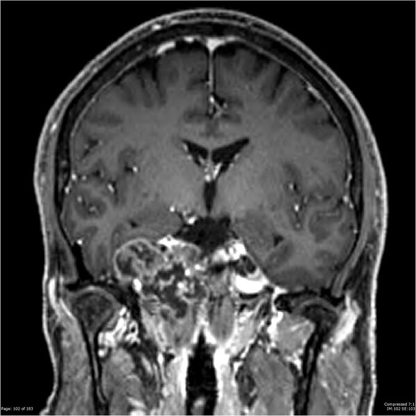 File:Chondrosarcoma of skull base- grade II (Radiopaedia 40948-43654 Coronal T1 C+ 13).jpg