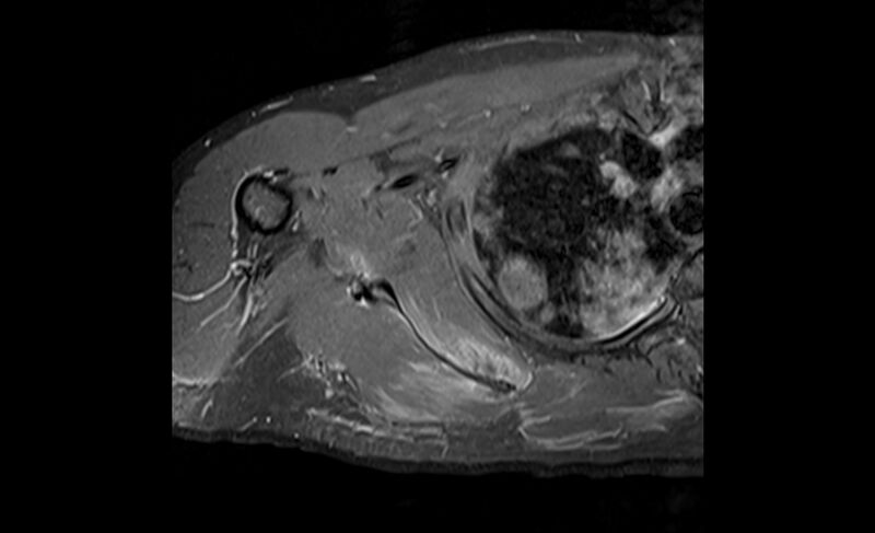 File:Choriocarcinoma in the shoulder (Radiopaedia 28603-28861 Axial T1 C+ fat sat 17).jpg