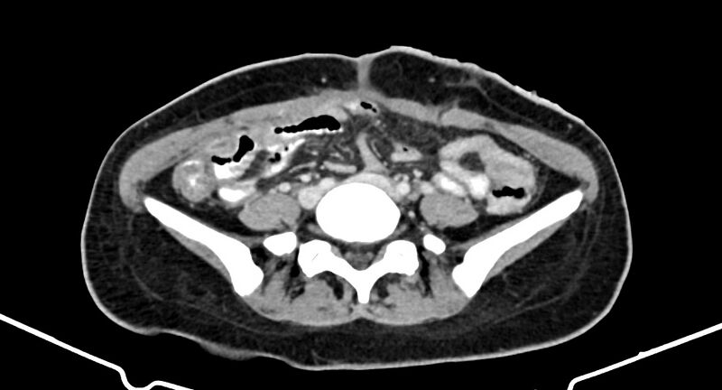 File:Choriocarcinoma liver metastases (Radiopaedia 74768-85766 A 139).jpg